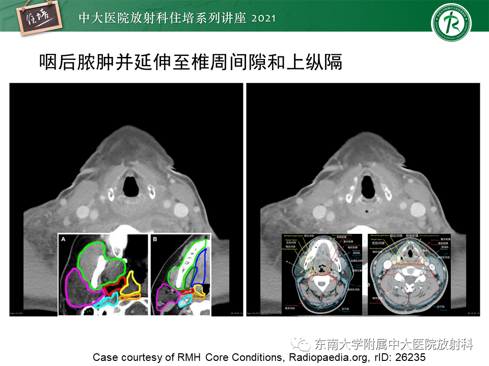影像PPT - 【PPT】颈部感染的影像诊断及蔓延途径-46