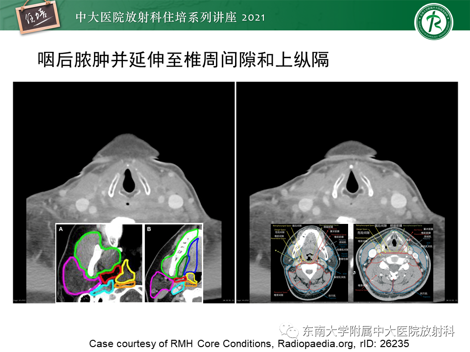 影像PPT - 【PPT】颈部感染的影像诊断及蔓延途径-47