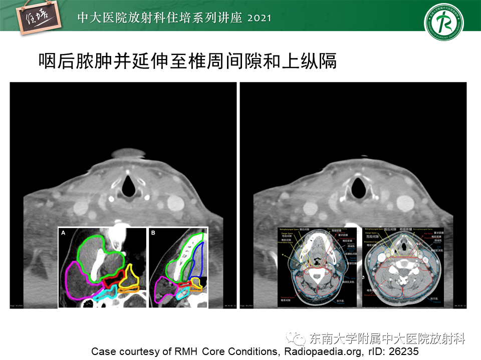 影像PPT - 【PPT】颈部感染的影像诊断及蔓延途径-48