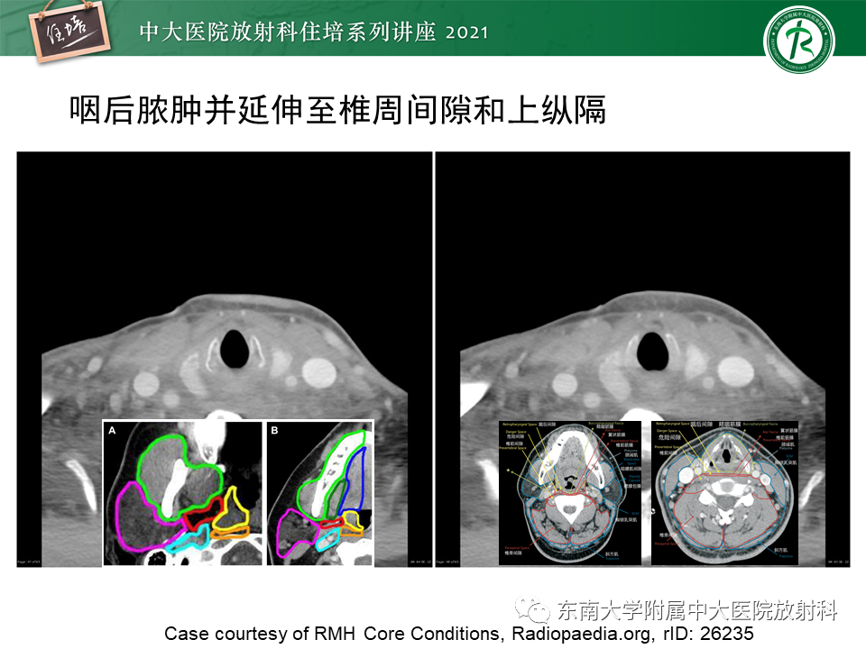 影像PPT - 【PPT】颈部感染的影像诊断及蔓延途径-49