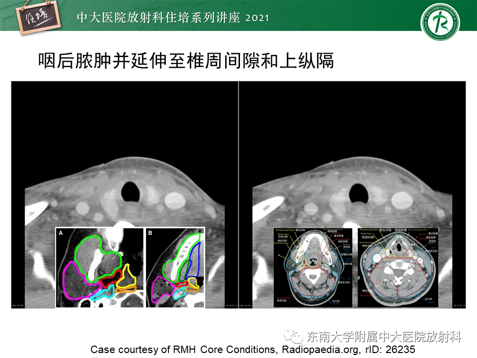 影像PPT - 【PPT】颈部感染的影像诊断及蔓延途径-50