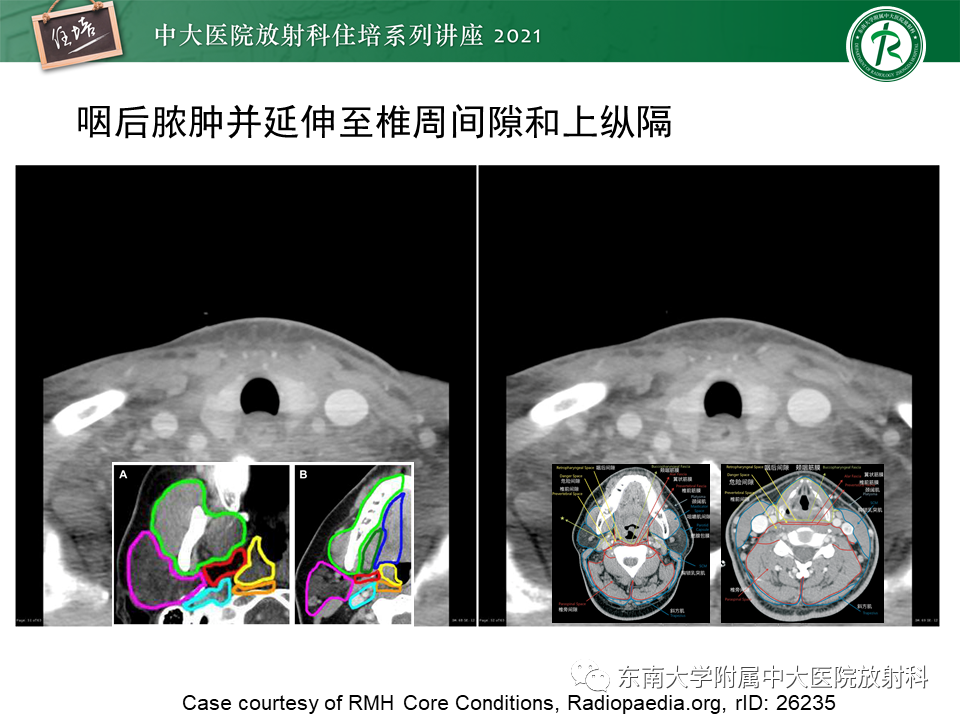 影像PPT - 【PPT】颈部感染的影像诊断及蔓延途径-51