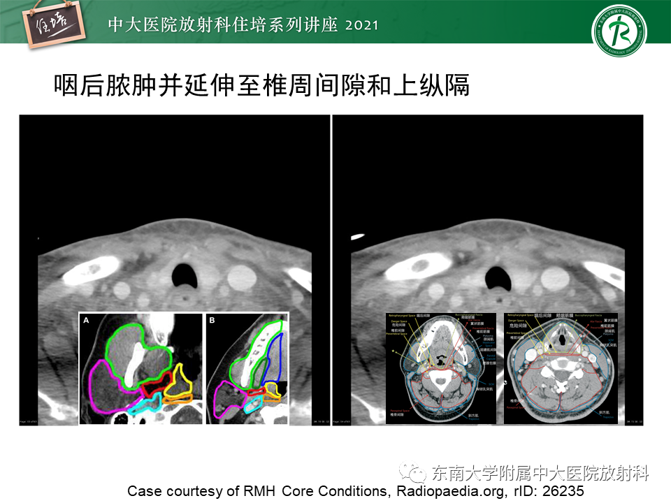 影像PPT - 【PPT】颈部感染的影像诊断及蔓延途径-52