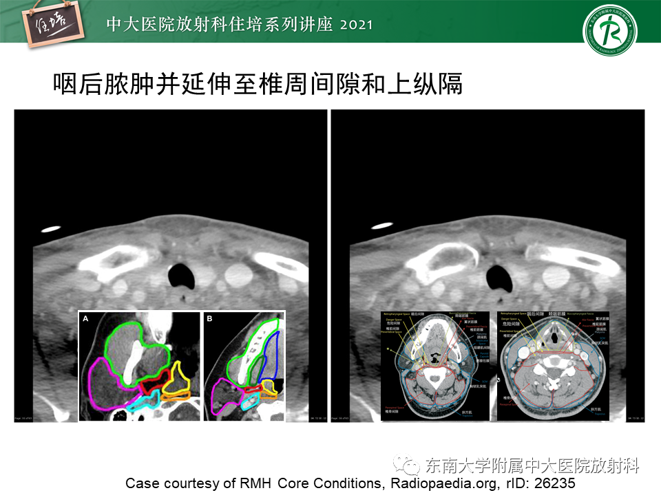 影像PPT - 【PPT】颈部感染的影像诊断及蔓延途径-53