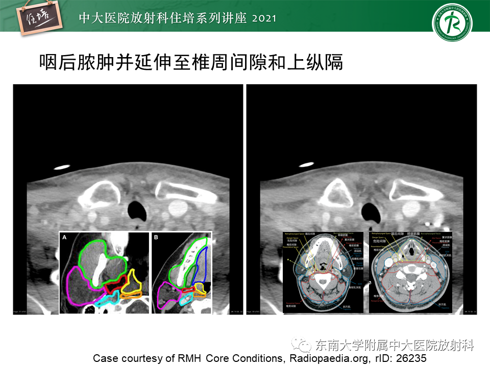 影像PPT - 【PPT】颈部感染的影像诊断及蔓延途径-54