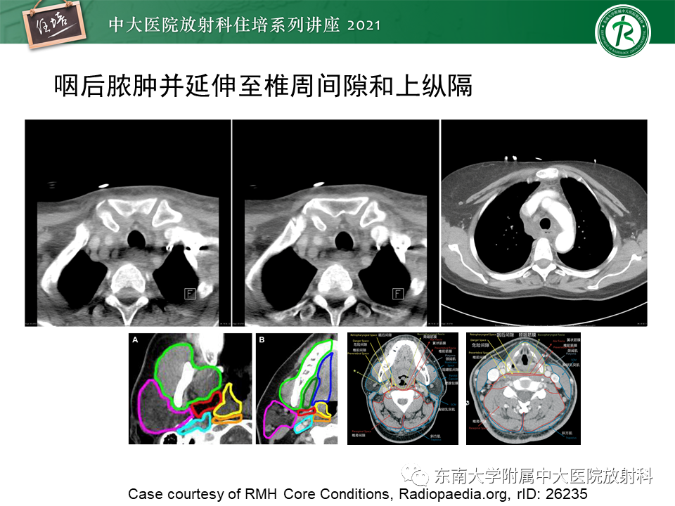 影像PPT - 【PPT】颈部感染的影像诊断及蔓延途径-55