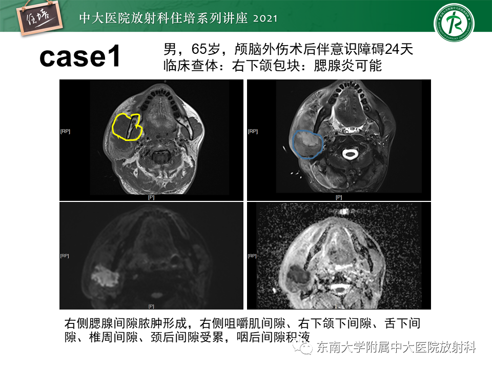 影像PPT - 【PPT】颈部感染的影像诊断及蔓延途径-56
