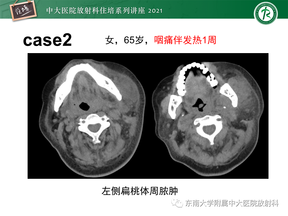 影像PPT - 【PPT】颈部感染的影像诊断及蔓延途径-57