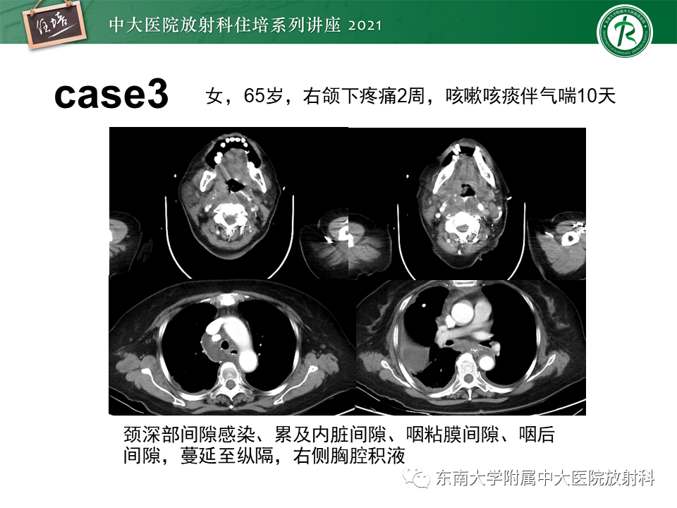 影像PPT - 【PPT】颈部感染的影像诊断及蔓延途径-58