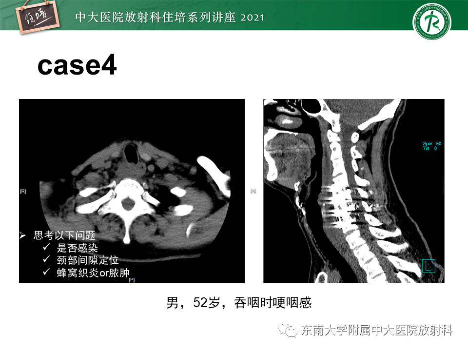 影像PPT - 【PPT】颈部感染的影像诊断及蔓延途径-59
