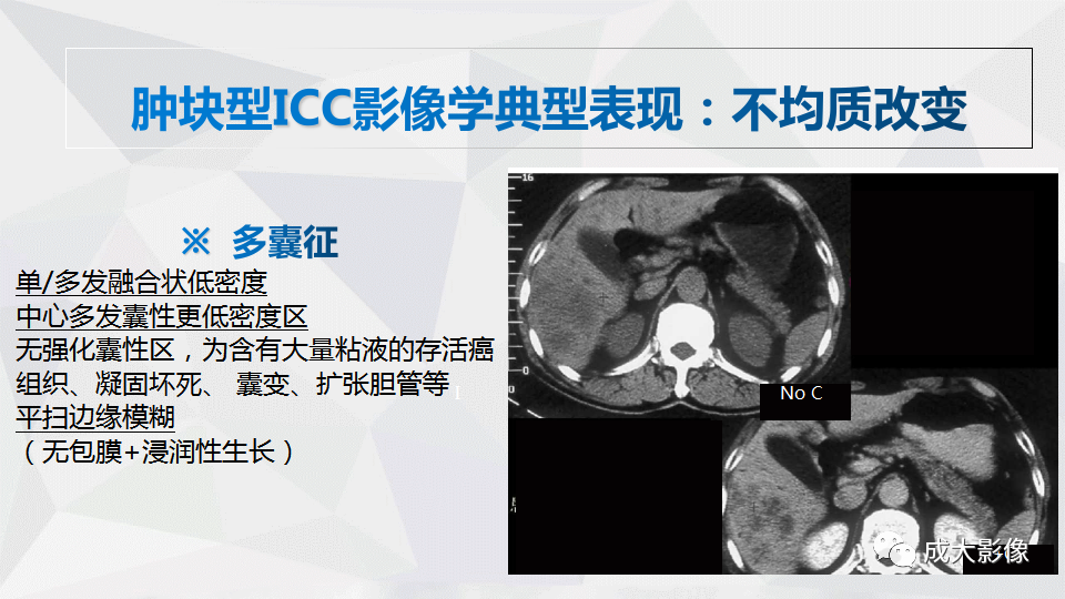 影像PPT - 【PPT】肿块型肝内胆管细胞癌影像学-8