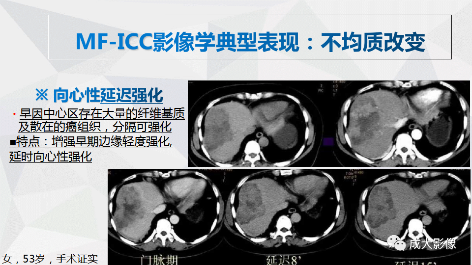 影像PPT - 【PPT】肿块型肝内胆管细胞癌影像学-10