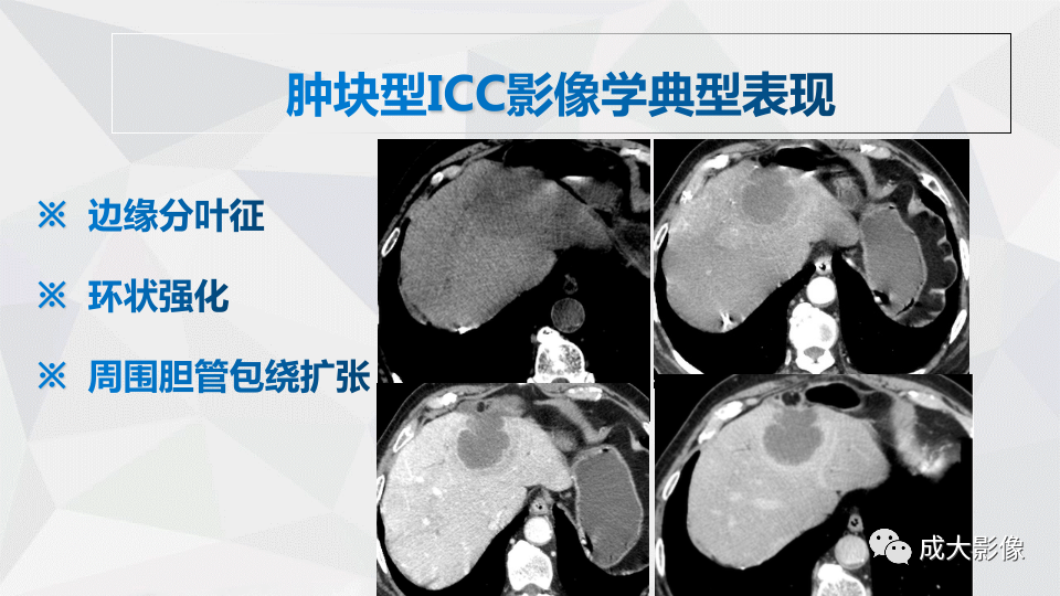 影像PPT - 【PPT】肿块型肝内胆管细胞癌影像学-12
