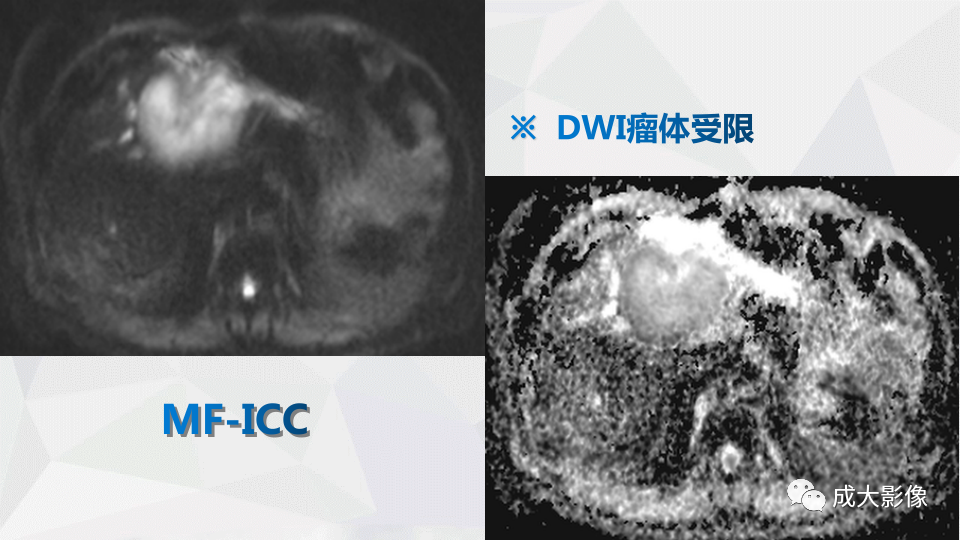 影像PPT - 【PPT】肿块型肝内胆管细胞癌影像学-15