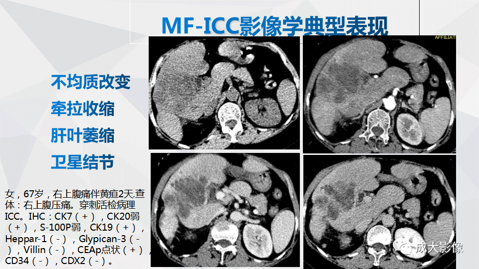 影像PPT - 【PPT】肿块型肝内胆管细胞癌影像学-16