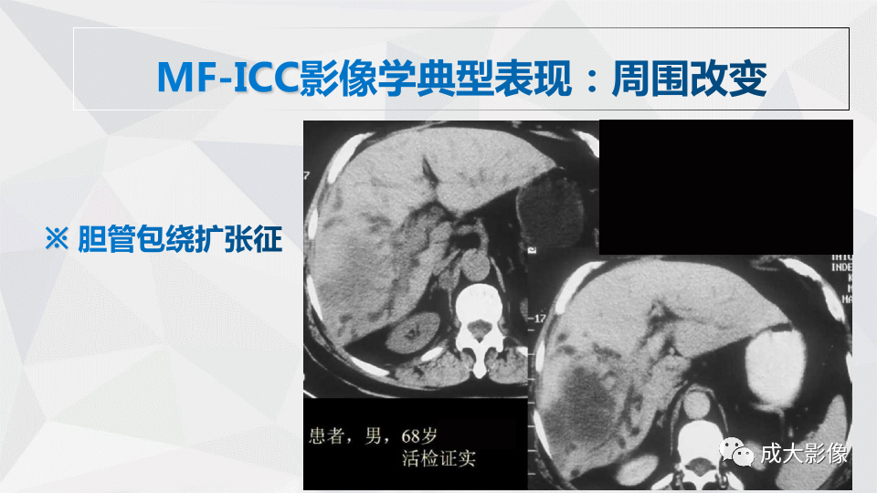 影像PPT - 【PPT】肿块型肝内胆管细胞癌影像学-17
