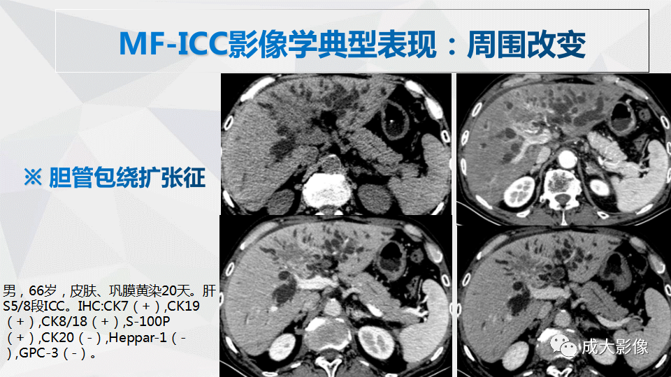 影像PPT - 【PPT】肿块型肝内胆管细胞癌影像学-18