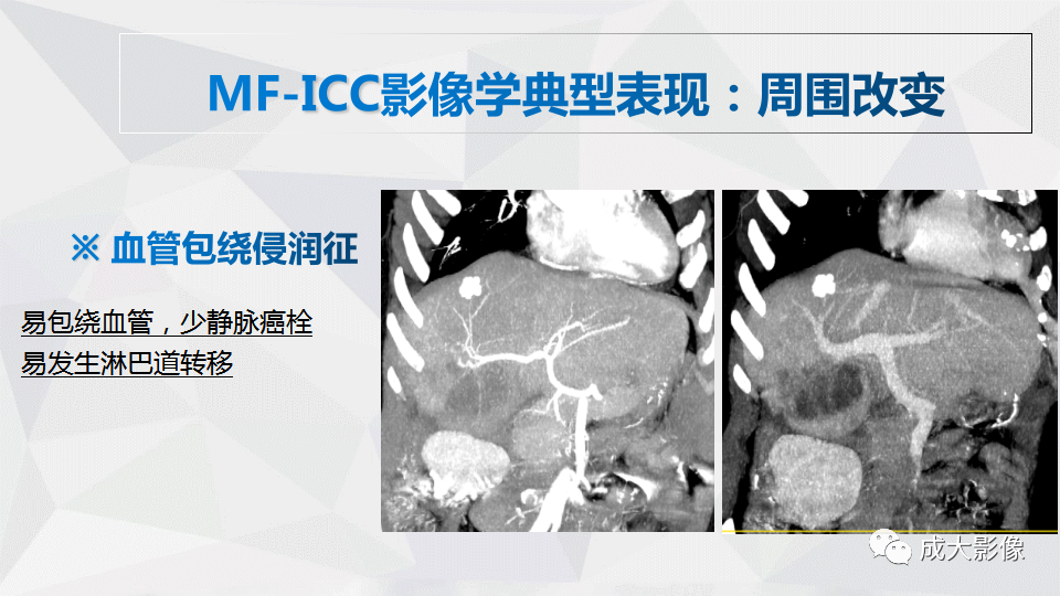 影像PPT - 【PPT】肿块型肝内胆管细胞癌影像学-19