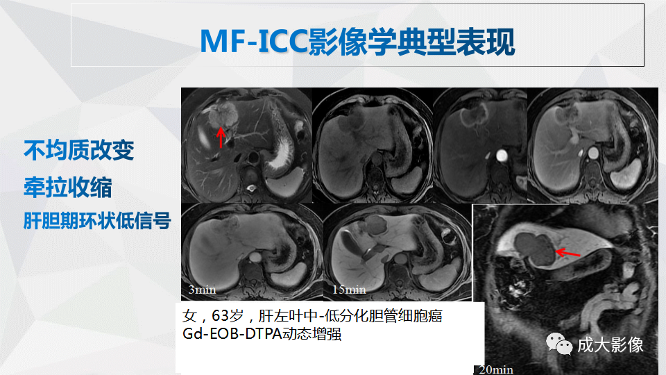 影像PPT - 【PPT】肿块型肝内胆管细胞癌影像学-20