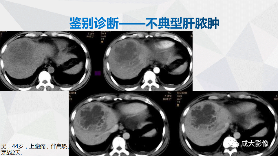 影像PPT - 【PPT】肿块型肝内胆管细胞癌影像学-23