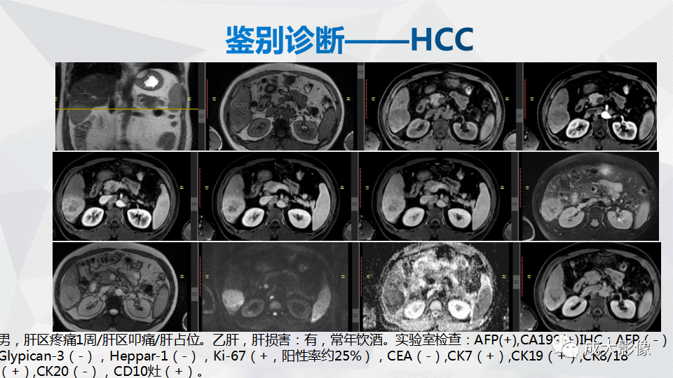 影像PPT - 【PPT】肿块型肝内胆管细胞癌影像学-27