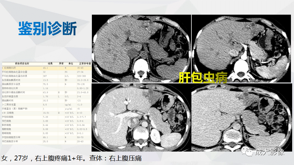 影像PPT - 【PPT】肿块型肝内胆管细胞癌影像学-30