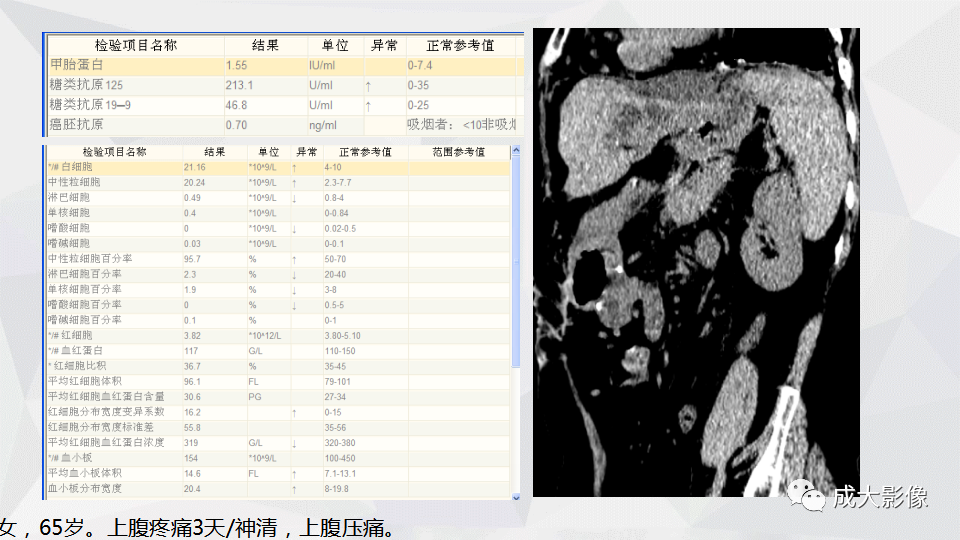 影像PPT - 【PPT】肿块型肝内胆管细胞癌影像学-31