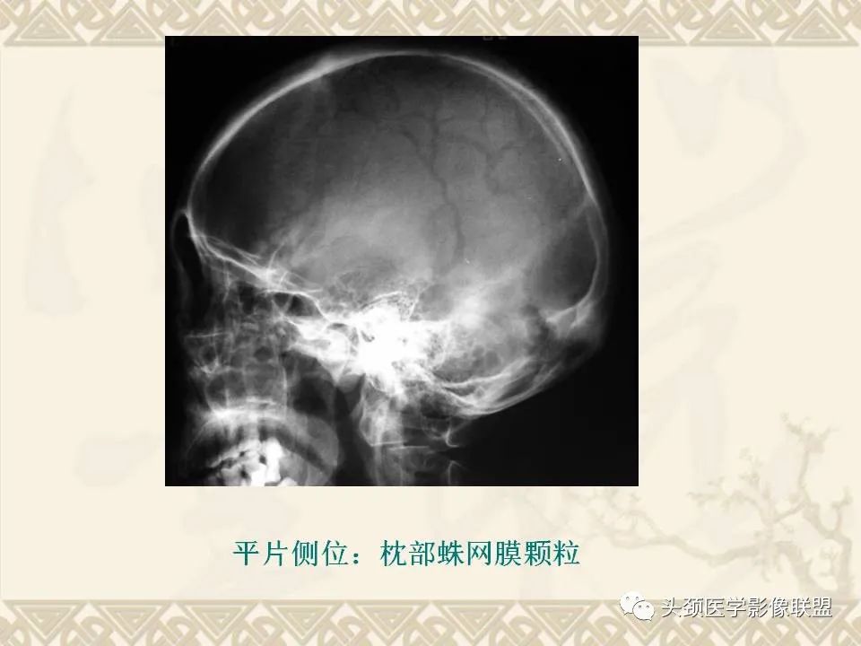 影像PPT - 【PPT】颅骨肿瘤的影像学诊断与鉴别诊断-4