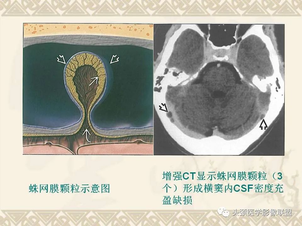 影像PPT - 【PPT】颅骨肿瘤的影像学诊断与鉴别诊断-3