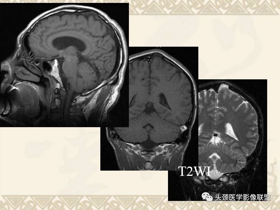 影像PPT - 【PPT】颅骨肿瘤的影像学诊断与鉴别诊断-8