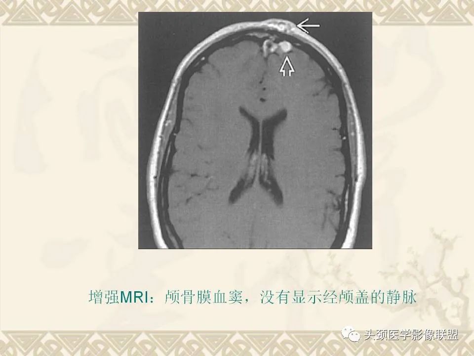 影像PPT - 【PPT】颅骨肿瘤的影像学诊断与鉴别诊断-10