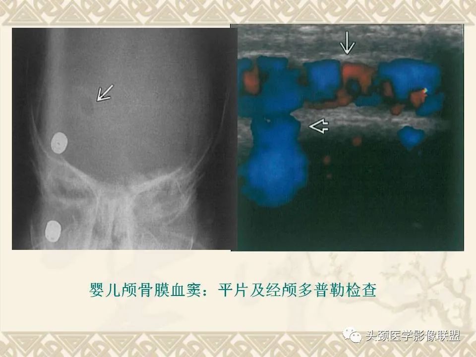 影像PPT - 【PPT】颅骨肿瘤的影像学诊断与鉴别诊断-11