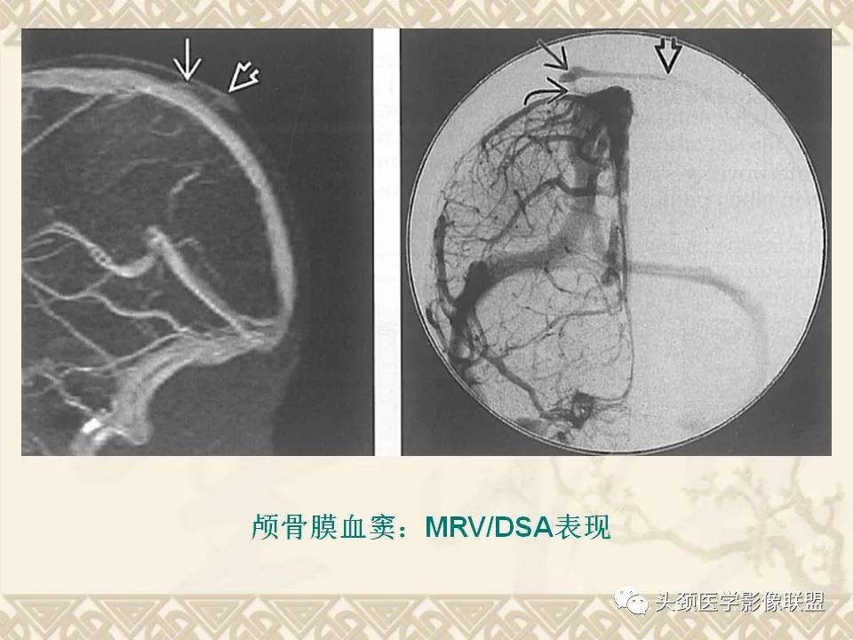 影像PPT - 【PPT】颅骨肿瘤的影像学诊断与鉴别诊断-13