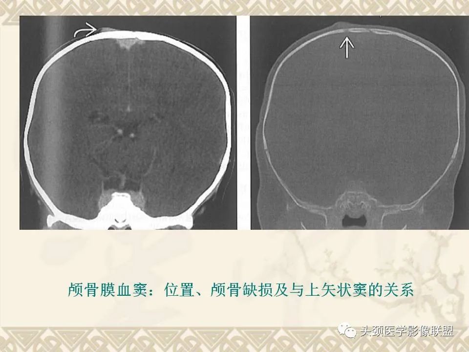 影像PPT - 【PPT】颅骨肿瘤的影像学诊断与鉴别诊断-12