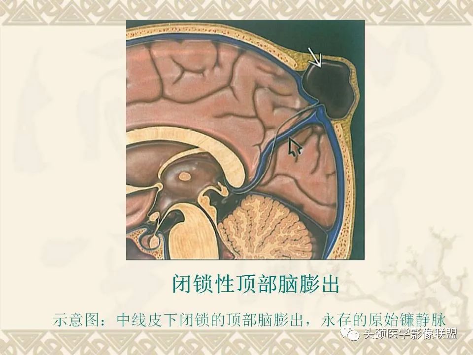 影像PPT - 【PPT】颅骨肿瘤的影像学诊断与鉴别诊断-14