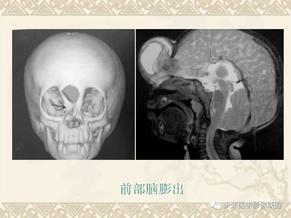 影像PPT - 【PPT】颅骨肿瘤的影像学诊断与鉴别诊断-16