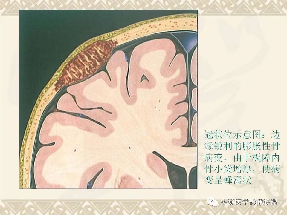 影像PPT - 【PPT】颅骨肿瘤的影像学诊断与鉴别诊断-19