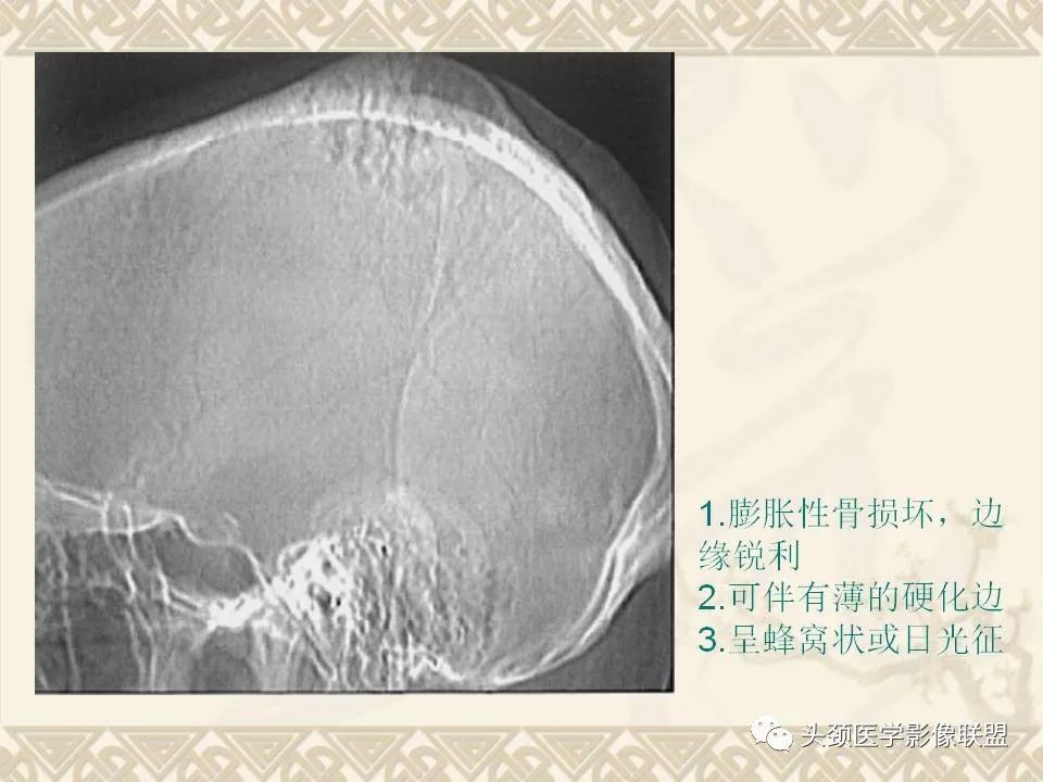 影像PPT - 【PPT】颅骨肿瘤的影像学诊断与鉴别诊断-20