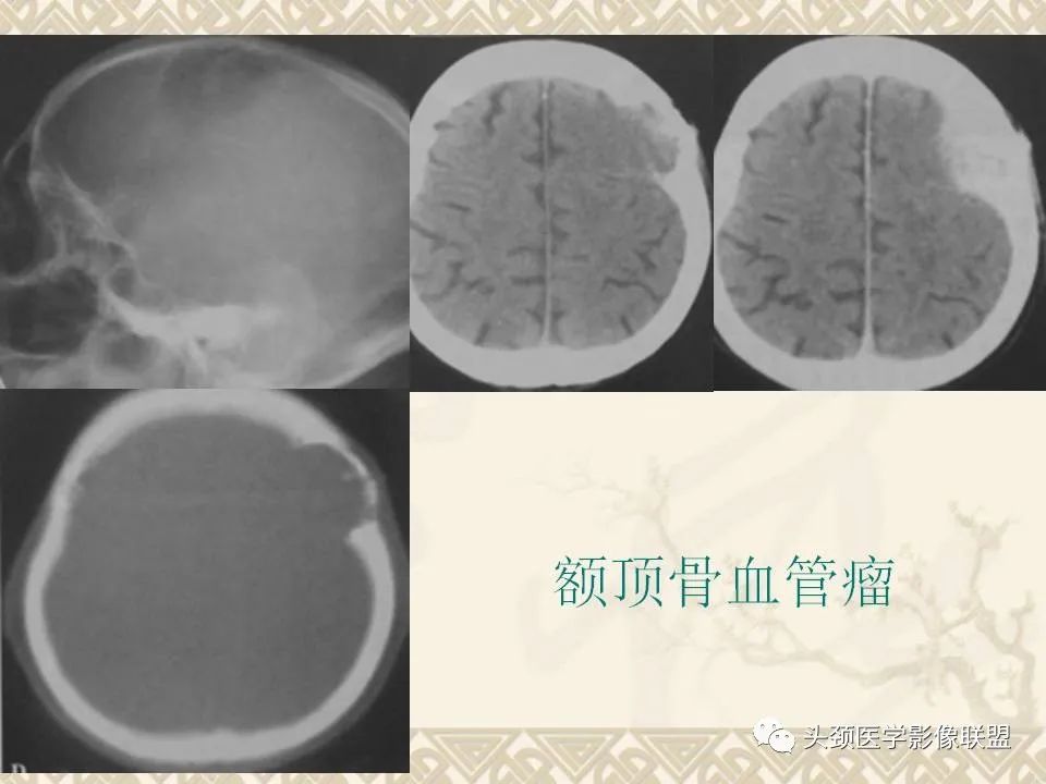 影像PPT - 【PPT】颅骨肿瘤的影像学诊断与鉴别诊断-23