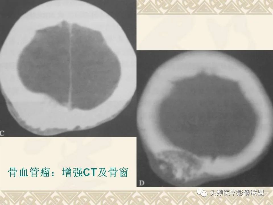 影像PPT - 【PPT】颅骨肿瘤的影像学诊断与鉴别诊断-22