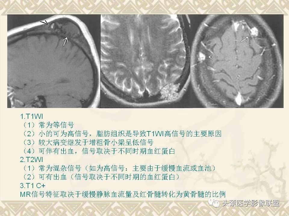 影像PPT - 【PPT】颅骨肿瘤的影像学诊断与鉴别诊断-24