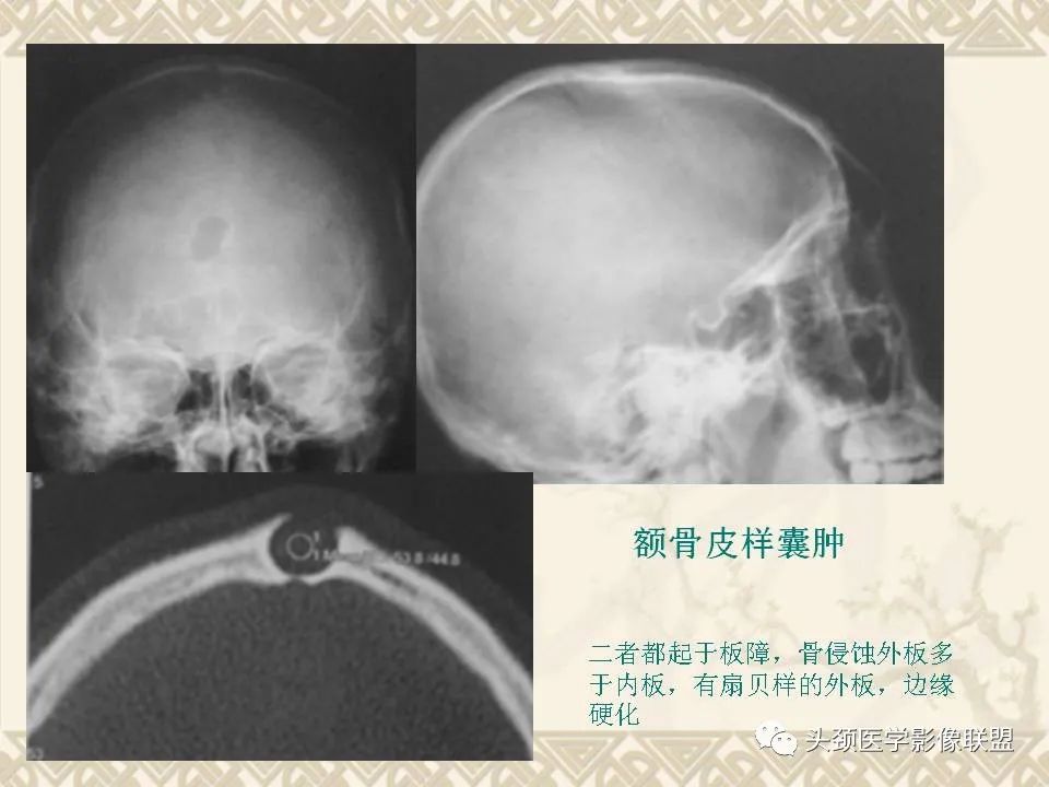 影像PPT - 【PPT】颅骨肿瘤的影像学诊断与鉴别诊断-26