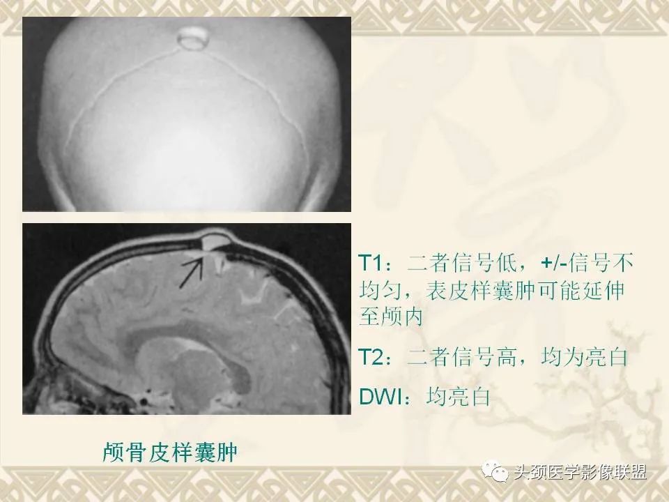 影像PPT - 【PPT】颅骨肿瘤的影像学诊断与鉴别诊断-28