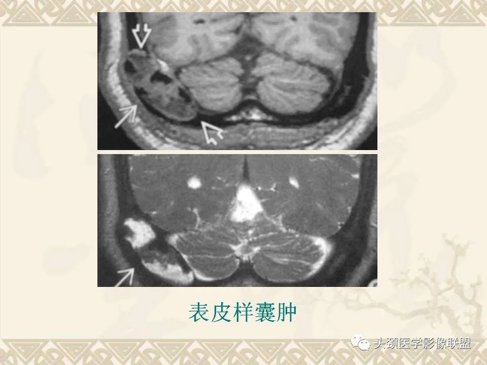 影像PPT - 【PPT】颅骨肿瘤的影像学诊断与鉴别诊断-29
