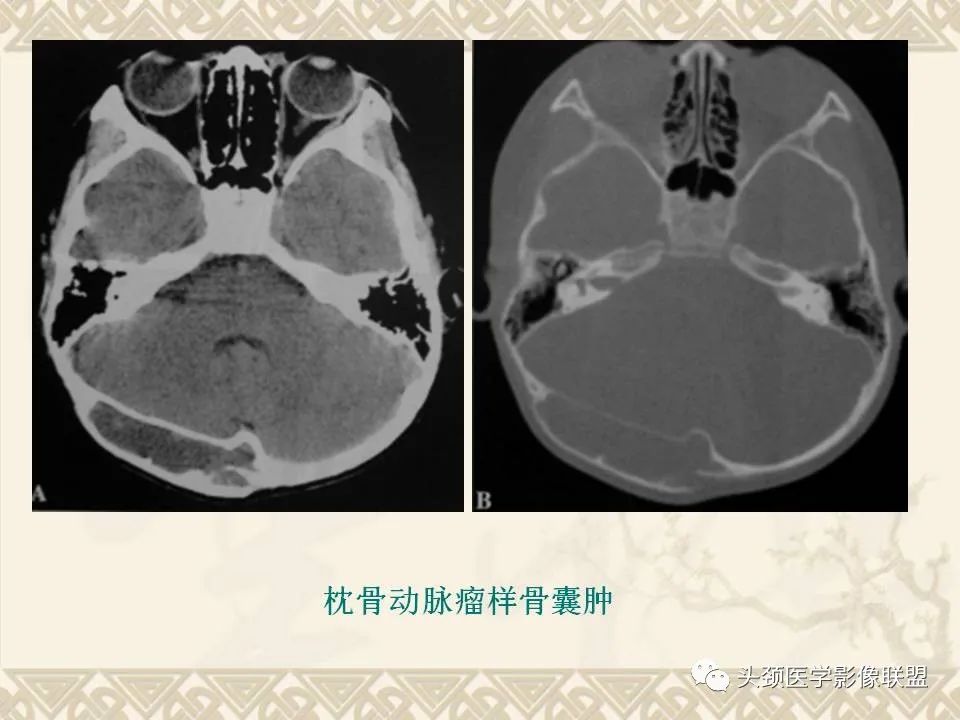 影像PPT - 【PPT】颅骨肿瘤的影像学诊断与鉴别诊断-31