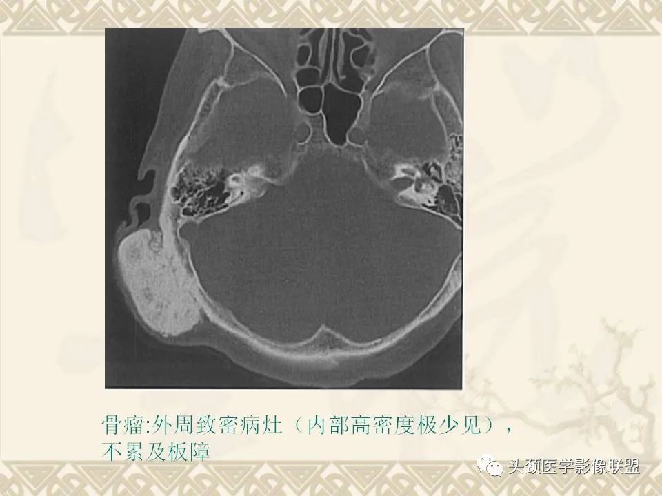 影像PPT - 【PPT】颅骨肿瘤的影像学诊断与鉴别诊断-34