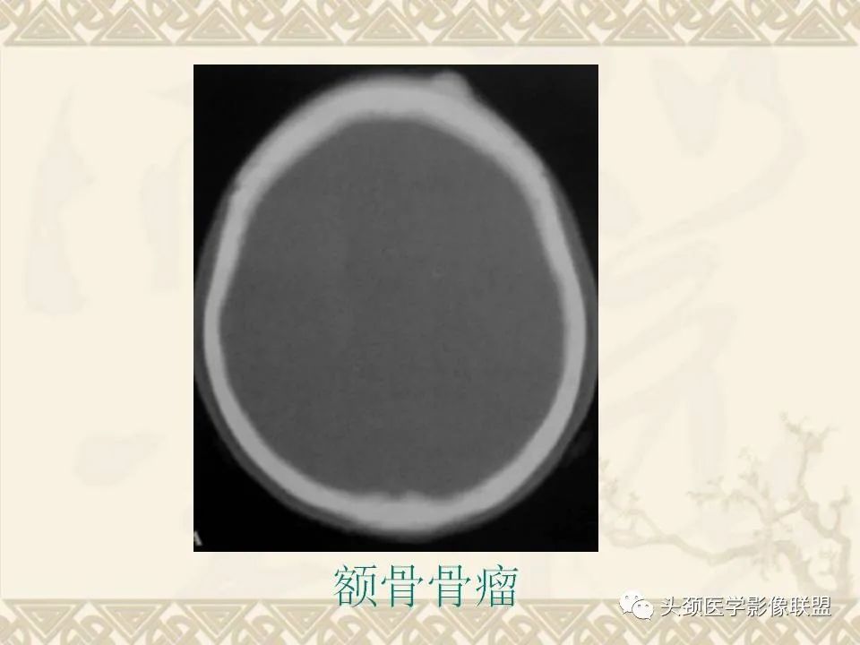 影像PPT - 【PPT】颅骨肿瘤的影像学诊断与鉴别诊断-36