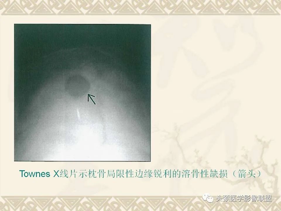 影像PPT - 【PPT】颅骨肿瘤的影像学诊断与鉴别诊断-39