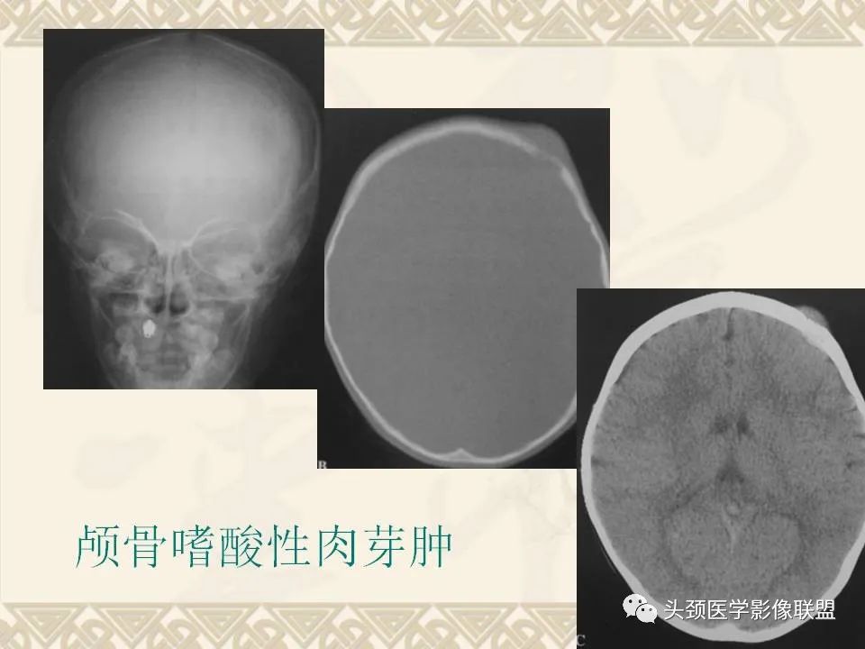 影像PPT - 【PPT】颅骨肿瘤的影像学诊断与鉴别诊断-40