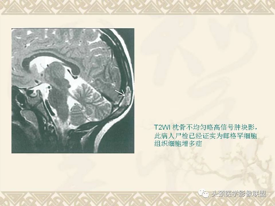 影像PPT - 【PPT】颅骨肿瘤的影像学诊断与鉴别诊断-41